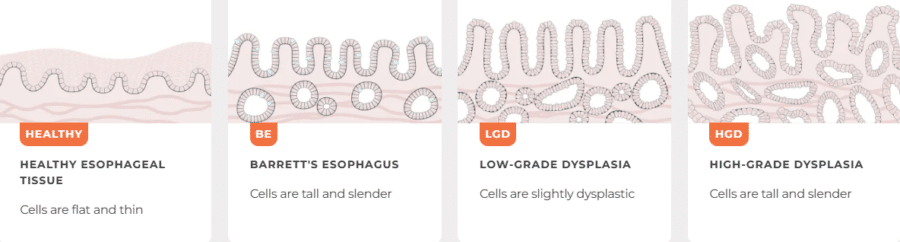 Diagram showing Barrett’s esophagus progression from normal esophageal tissue to low-grade dysplasia and high-grade dysplasia
