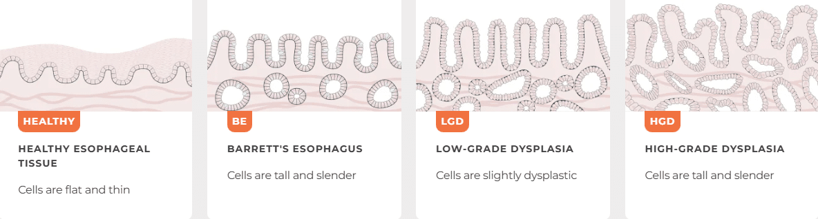 Diagram showing Barrett’s esophagus progression from normal esophageal tissue to low-grade dysplasia and high-grade dysplasia